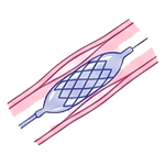 Angioplastia Coronária (Implante de STENT)